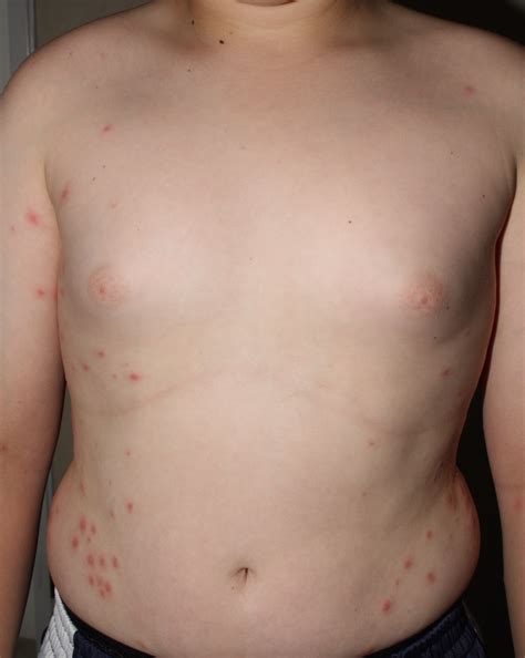 Hot Tub Folliculitis Rd