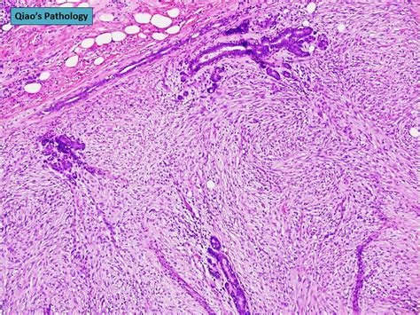 Qiao S Pathology Malignant Phyllodes Tumor Of The Breast A Photo On