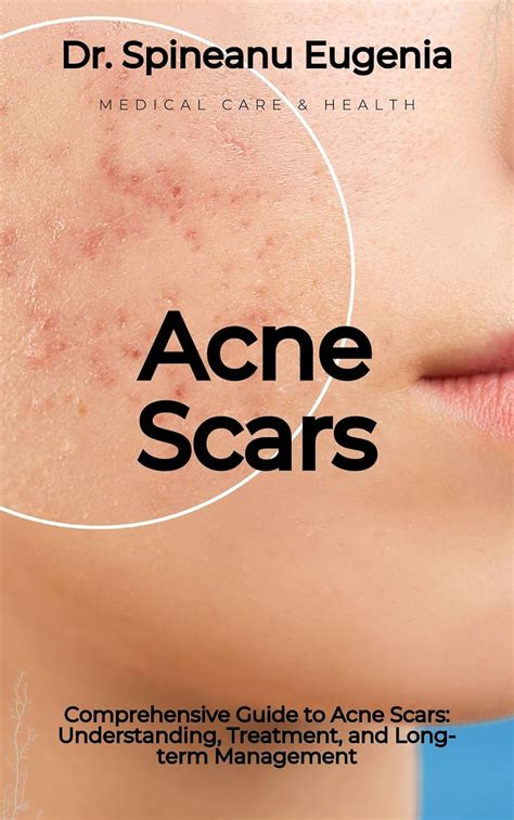 Amazon Comprehensive Guide To Acne Scars Understanding Treatment