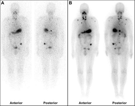 Updated Review Of Nuclear Molecular Imaging Of Thyroid Cancers