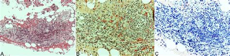 Bone Marrow Biopsy Hematoxylin And Eosin Hande Stain Showing Nodular