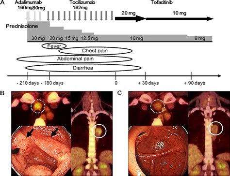 Successful Remission With Tofacitinib In A Patient With Refractory