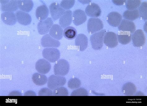 Thin Film Micrograph Of A Growing Rounded Plasmodium Malariae Trophozoite Within A Slightly