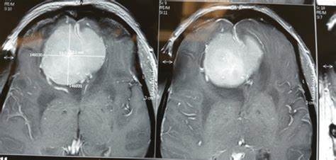 Meningioma: Causes, Symptoms and Treatment