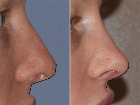 Female Rhinoplasty Result Nasolabial Angle Lines Side View Dr Barry