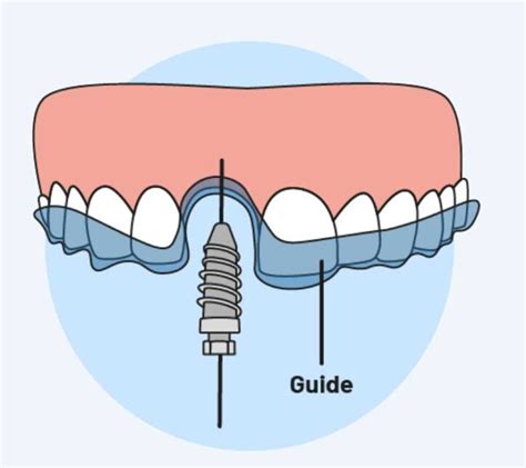 3D Guided Implant Surgery DentisTree Dental Clinic