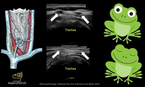 NephroPOCUS On Twitter POCUS Helps In Identifying Vessels In The Pre