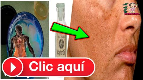 Para Las Verrugas Lunares Fibromas Espinillas Y Manchas De La Edad