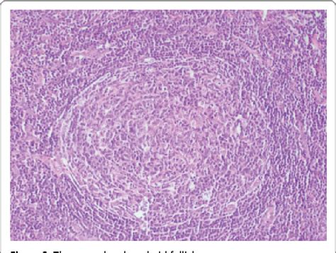 Figure 2 From Castlemans Disease About A Case Semantic Scholar