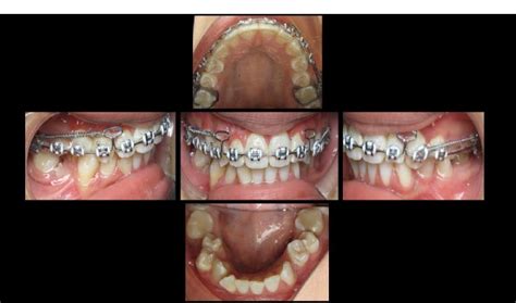 Fig 3 Intraoral Photograph After 15 Months Of Orthodontic Treatment