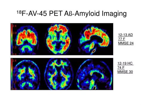 PPT 18 F AV 45 PET A ß Amyloid Imaging PowerPoint Presentation free