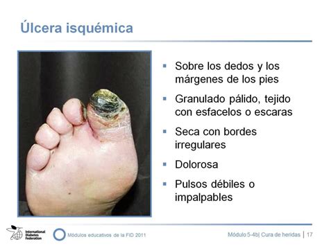 PPT NEUROPATÍA Diabética Y CURA DE HERIDAS EN LA EVP PowerPoint