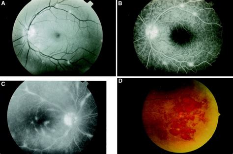 Sarcoidosis and the eye - Ocular Manifestations Of Systemic Disease