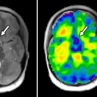 Axial Anatomical Image And Mr Elastography Stiffness Map From A