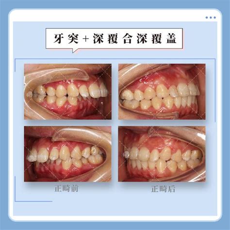 北京牙齿矫正｜不拔牙矫正嘴会越来越突吗？ 知乎