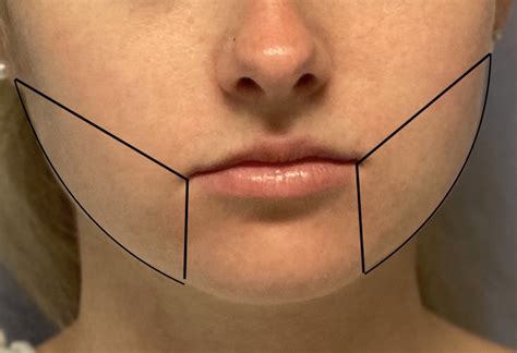 The Safety And Effectiveness Of Perioral Liposuction Explore Plastic