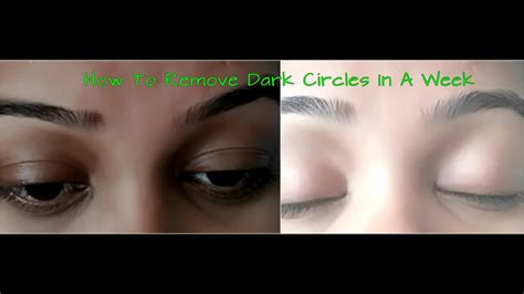 Remove Dark Circles Naturally At Home In A Week Permanently How To