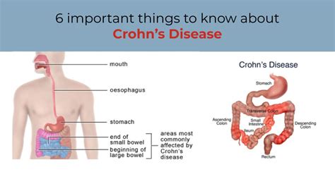 The Crohn's Conundrum: 5 Red Flags That Could Mean You Need To See A Doctor