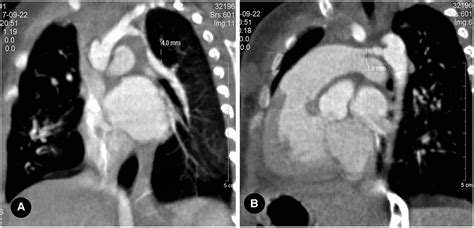 Frontiers Proximal Interruption Of The Pulmonary Artery A Review Of