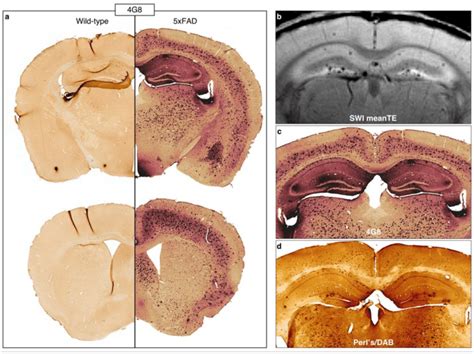 Histology shows iron containing Aβ plaques throughout the brain in