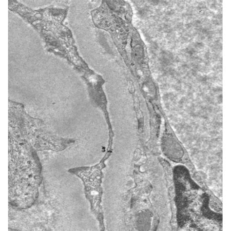 Kidney Biopsy Images A Glomeruli With Cellular Crescents One Of