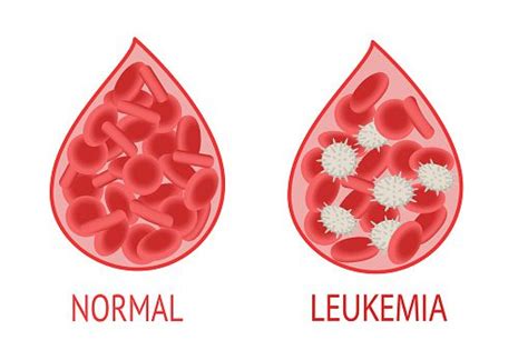 Leukemia Symptoms Causes And Treatment Beardy Nerd