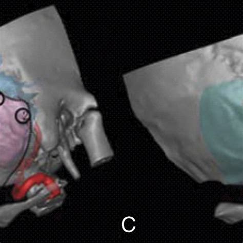 Pdf An In Situ Repositioning Bone Flap In Retrosigmoid Craniotomy For Cranial Reconstruction