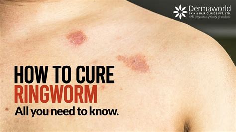 Ringworm Pictures Symptoms What Does Ringworm Look Like 43 Off