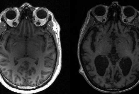 Cientistas Descobrem Os Motivos Do Avan O Do Alzheimer No C Rebro