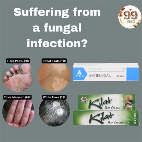 Anti Fungal Creams 抗真菌霜（kilat Skin Cream Ysp Anti Fungal Cream Itch Relief Herbal Cream 百草小乳膏