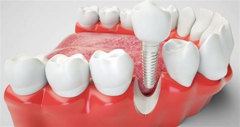 The Top 2 Dental Implant Alternatives A Complete Guide