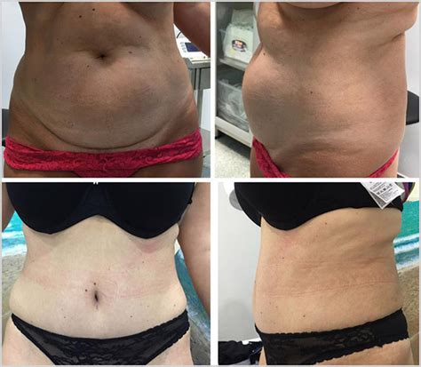 Abdominoplasty Tummy Tuck Turkey Dental Clinic Turkey