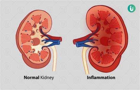 Nephritis: symptoms, causes, treatment, medicine, prevention, diagnosis