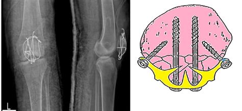 Fractura De R Tula Tratamiento Rehabilitaci N Y Tiempo De Curaci N