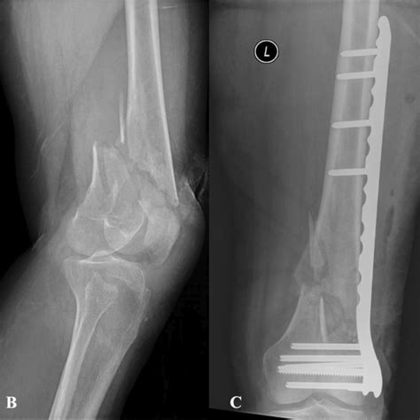 Distal Femoral Fracture