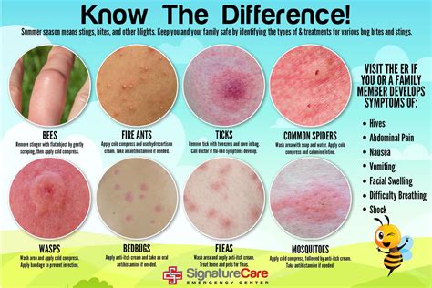 Its Summer And That Means A Higher Risk Of Bites And Stings While Out