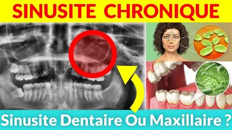 Sinusite Dentaireou Maxillaire C est Quoi la Différence Ça TIRE dans