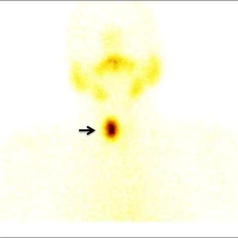 Anterior Planar Static Images Of The Tc M Pertechnetate Thyroid Scan