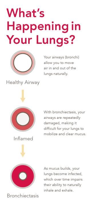 Congested Lungs: Causes, Symptoms, and Treatment | SmartVest