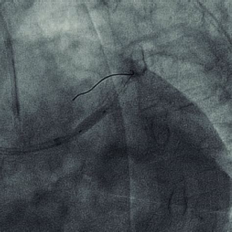 Implantation of a drug-eluting stent in the left main coronary artery. | Download Scientific Diagram