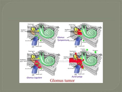 Tumors Of External And Middle Ear Tumors Of