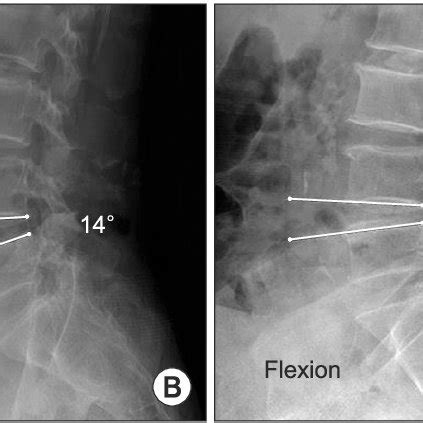 Preoperative Flexion A And Extension B And One Year Postoperative