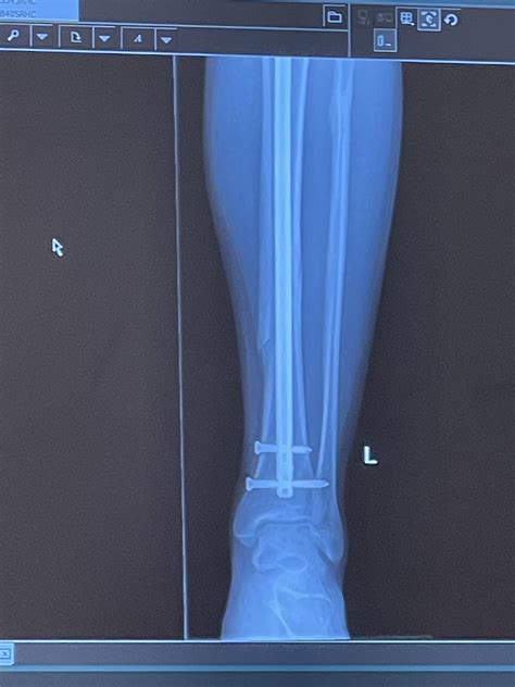 Leg X-ray after 2.5 months : r/brokenbones