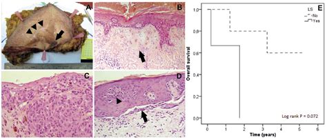 Vulvar Melanoma Cancer