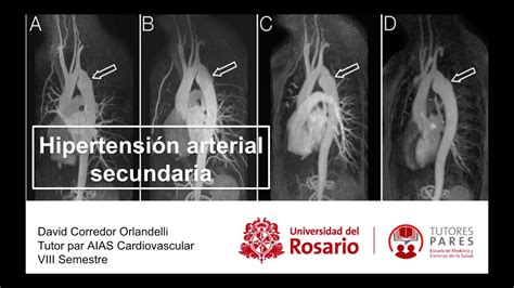 Hipertensi N Arterial Secundaria Youtube