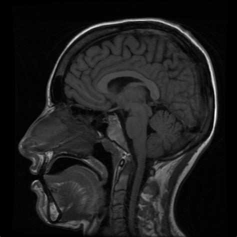 Subarachnoid Cisterns Stroke Manual