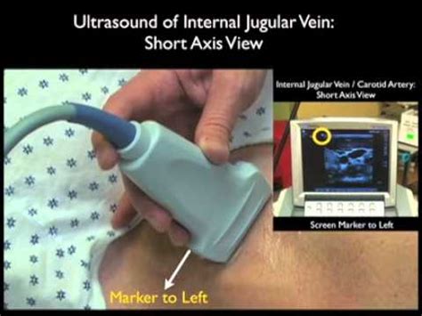 Ultrasound Guidance For Central Venous Access Part 1 YouTube