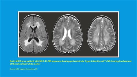 Neurology Quiz #103 Metachromatic leukodystrophy (MLD) - YouTube