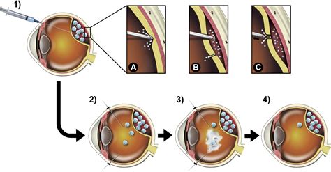 An Optimized Treatment Protocol For Subretinal Injections Limits