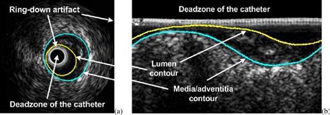 Figure 3 From Shape Driven Segmentation Of The Arterial Wall In Intravascular Ultrasound Images